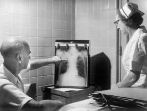 Pulmonary fibrosis Pulmonary fibrosis